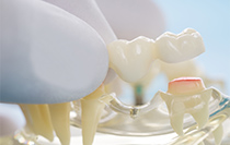 赤坂インプラント治療専門サイト｜赤坂B&S歯科・矯正歯科｜ブリッジ