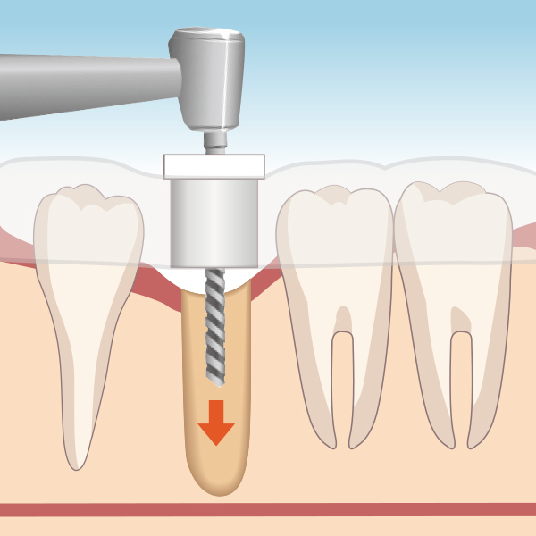 赤坂インプラント治療専門サイト｜赤坂B&S歯科・矯正歯科｜ガイドあり
