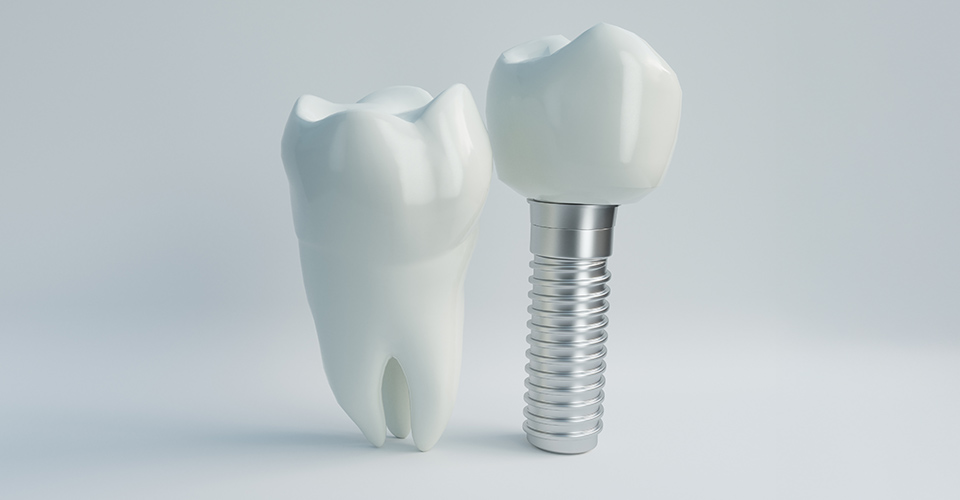 赤坂インプラント治療専門サイト｜赤坂B&S歯科・矯正歯科｜保証制度