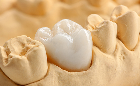 赤坂インプラント治療専門サイト｜赤坂B&S歯科・矯正歯科｜周囲への影響が少ない