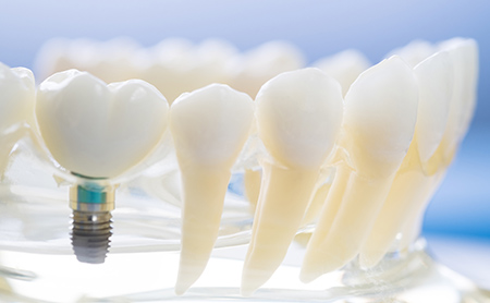 赤坂インプラント治療専門サイト｜赤坂B&S歯科・矯正歯科｜取り外し不要で快適