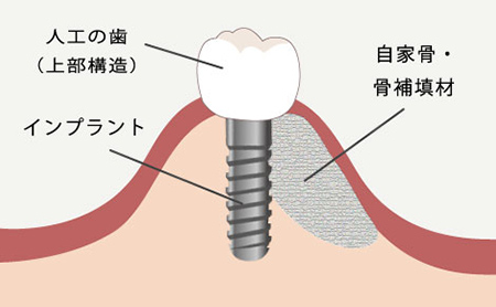 赤坂インプラント治療専門サイト｜赤坂B&S歯科・矯正歯科｜GBR