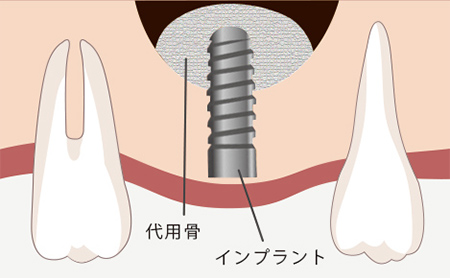 赤坂インプラント治療専門サイト｜赤坂B&S歯科・矯正歯科｜ソケットリフト