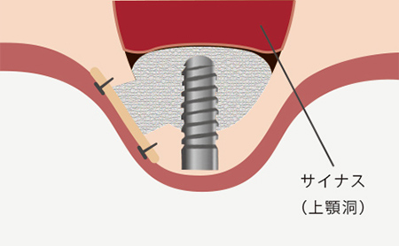 赤坂インプラント治療専門サイト｜赤坂B&S歯科・矯正歯科｜サイナスリフト
