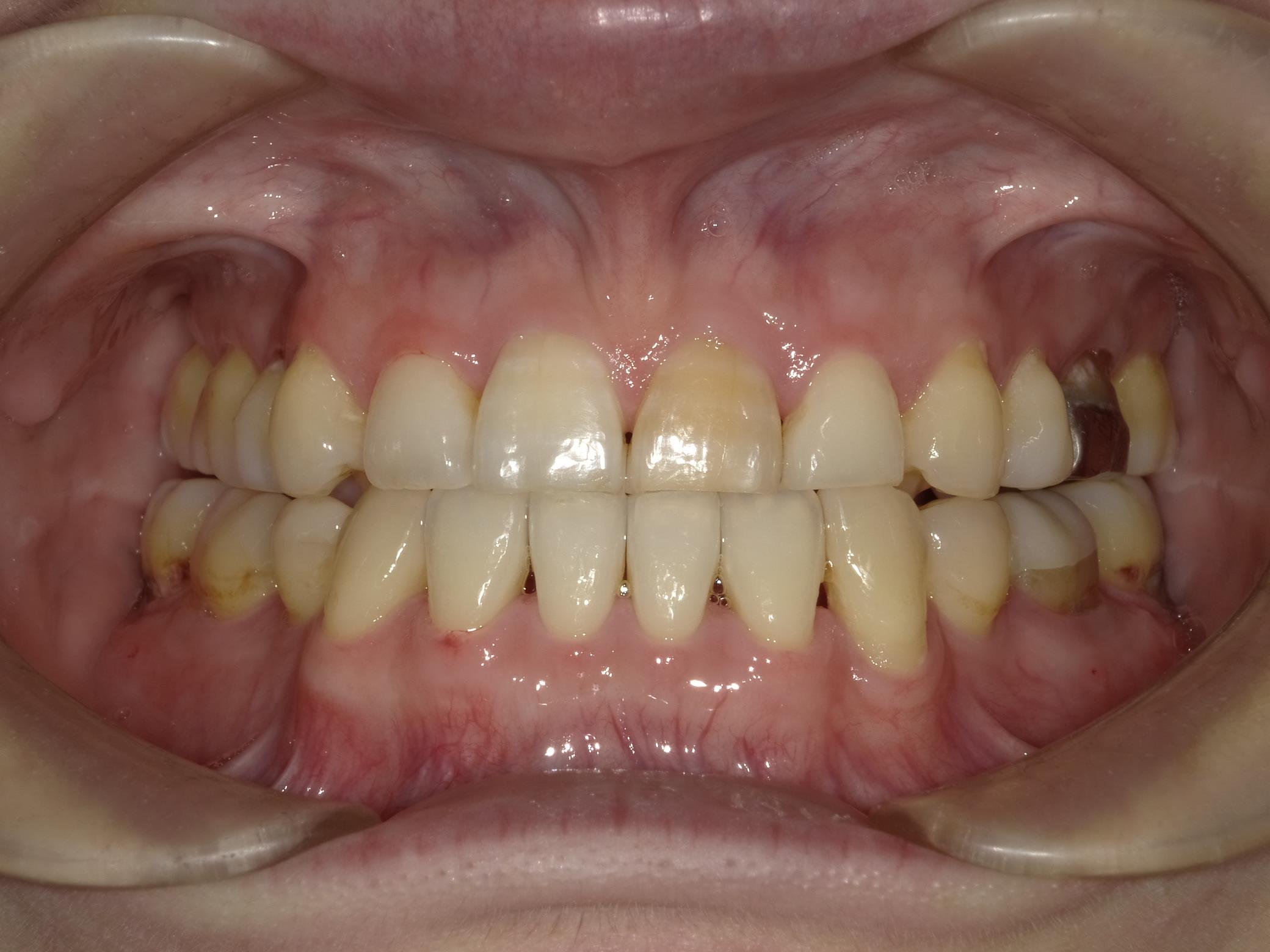 Case 05 After