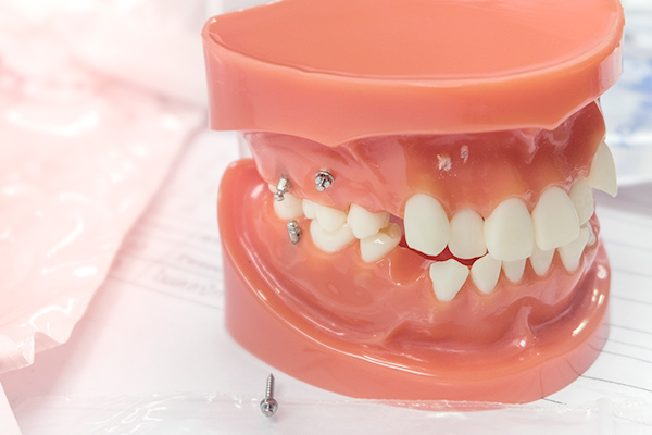 港区赤坂・赤坂見附の歯医者・矯正歯科「赤坂B&S歯科・矯正歯科」｜インプラントアンカー