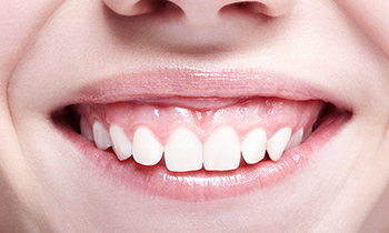 港区赤坂・赤坂見附の歯医者・矯正歯科「赤坂B&S歯科・矯正歯科」|ガミースマイルの治療