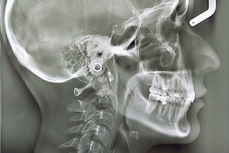 港区赤坂・赤坂見附の歯医者・矯正歯科「赤坂B&S歯科・矯正歯科」｜セファロレントゲン