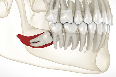 港区赤坂・赤坂見附の歯医者・矯正歯科「赤坂B&S歯科・矯正歯科」｜歯の移植