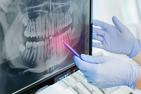 港区赤坂・赤坂見附の歯医者・矯正歯科「赤坂B&S歯科・矯正歯科」｜移植した歯の移動