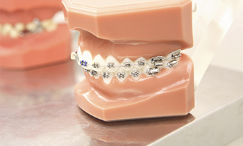 港区赤坂・赤坂見附の歯医者・矯正歯科「赤坂B&S歯科・矯正歯科」|ブラケット矯正