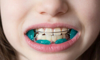 港区赤坂・赤坂見附の歯医者・矯正歯科「赤坂B&S歯科・矯正歯科」|機能的顎矯正装置